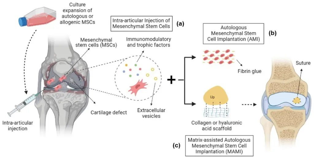 knee injury stem cell therapy