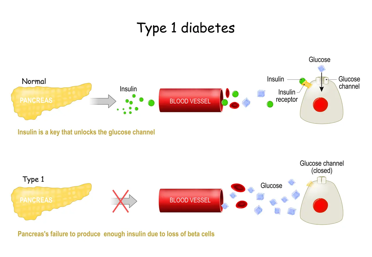 Types 1 of Diabetes Mellitus.