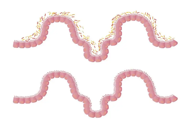 Fecal Microbiota Transplant FMT