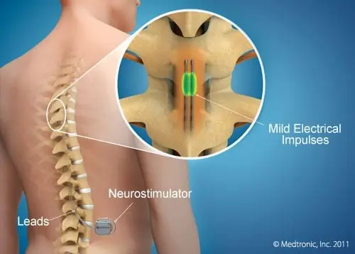 Epidural Stimulation Stem Cell Treatment