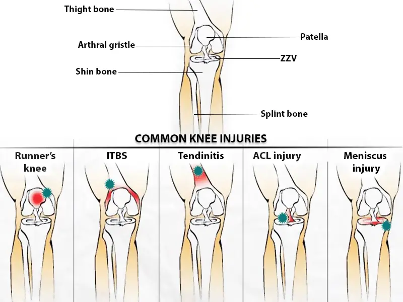 Common Types of Knee Injuries