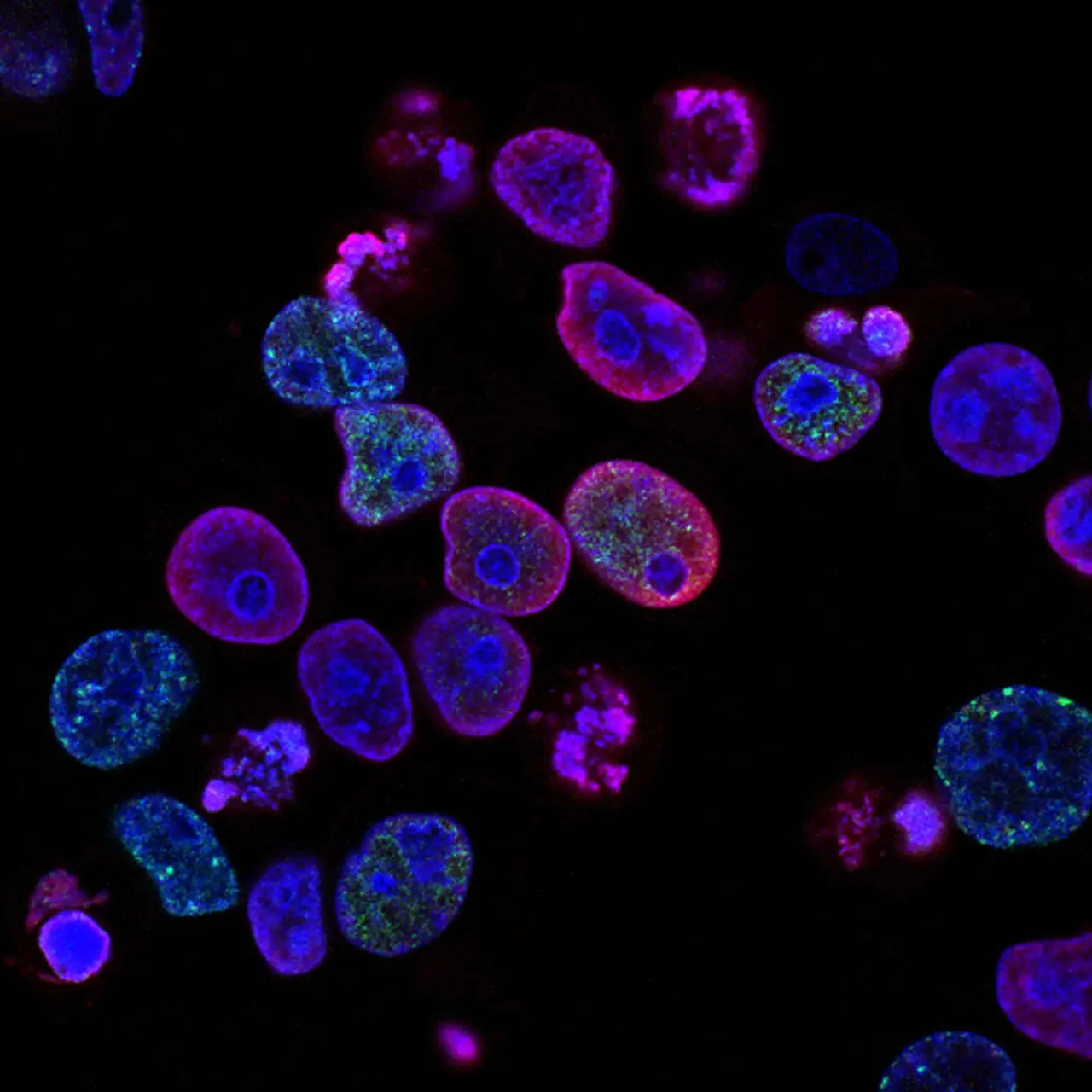 How effective is it to use a donor's stem cells?