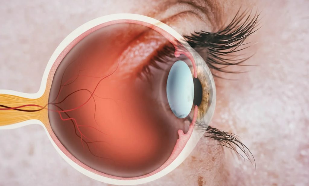 Optic Nerve Hypoplasia