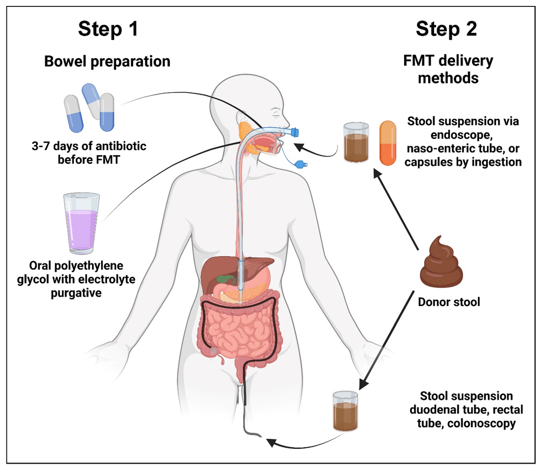 The two stages of a fecal microbiota transplant: bowel preparation and FMT delivery methods
